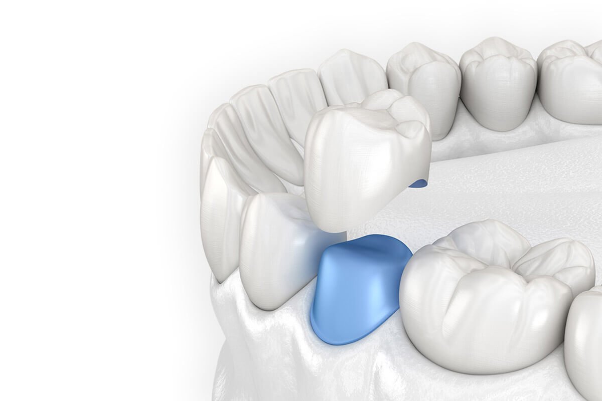 Schulterpräparation